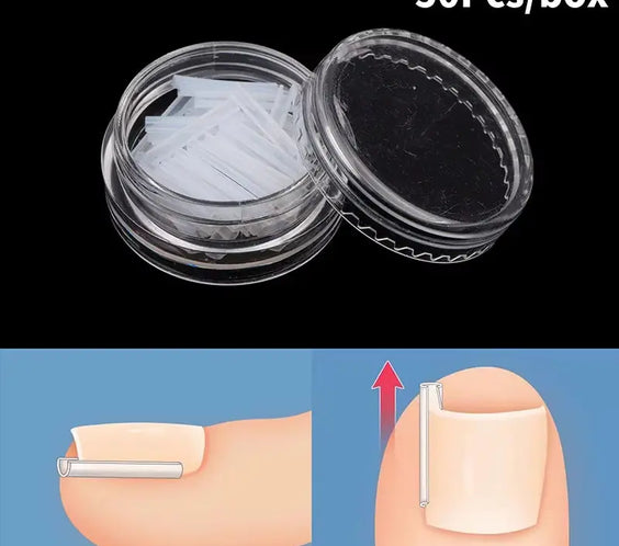 50Pcs Ingrown Toenail Correction Tool Ingrown Toe Nail Treatment Elastic Patch Sticker Straightening Clip Brace Pedicure Tool