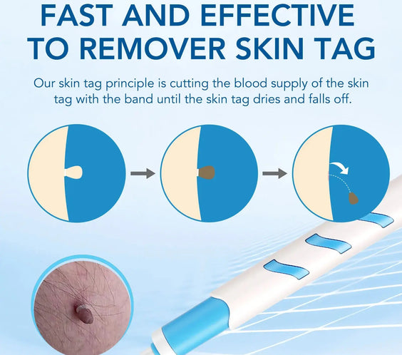 3 In1 Painless Auto Skin Tag Mole Wart Removal Kit Cleaning Tool Care Body Wart Dot Treatment for 1-4Mm Beauty Health Hot Sale