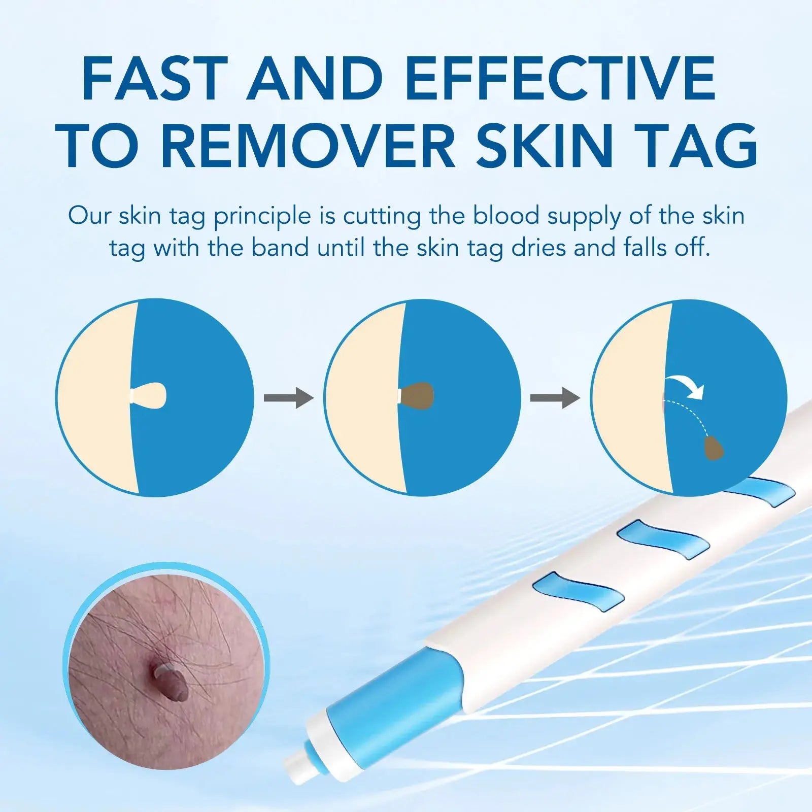 3 In1 Painless Auto Skin Tag Mole Wart Removal Kit Cleaning Tool Care Body Wart Dot Treatment for 1-4Mm Beauty Health Hot Sale