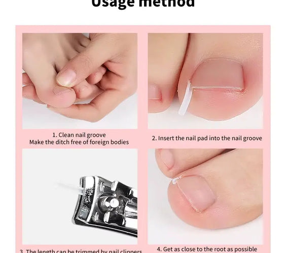 50Pcs Ingrown Toenail Correction Tool Ingrown Toe Nail Treatment Elastic Patch Sticker Straightening Clip Brace Pedicure Tool